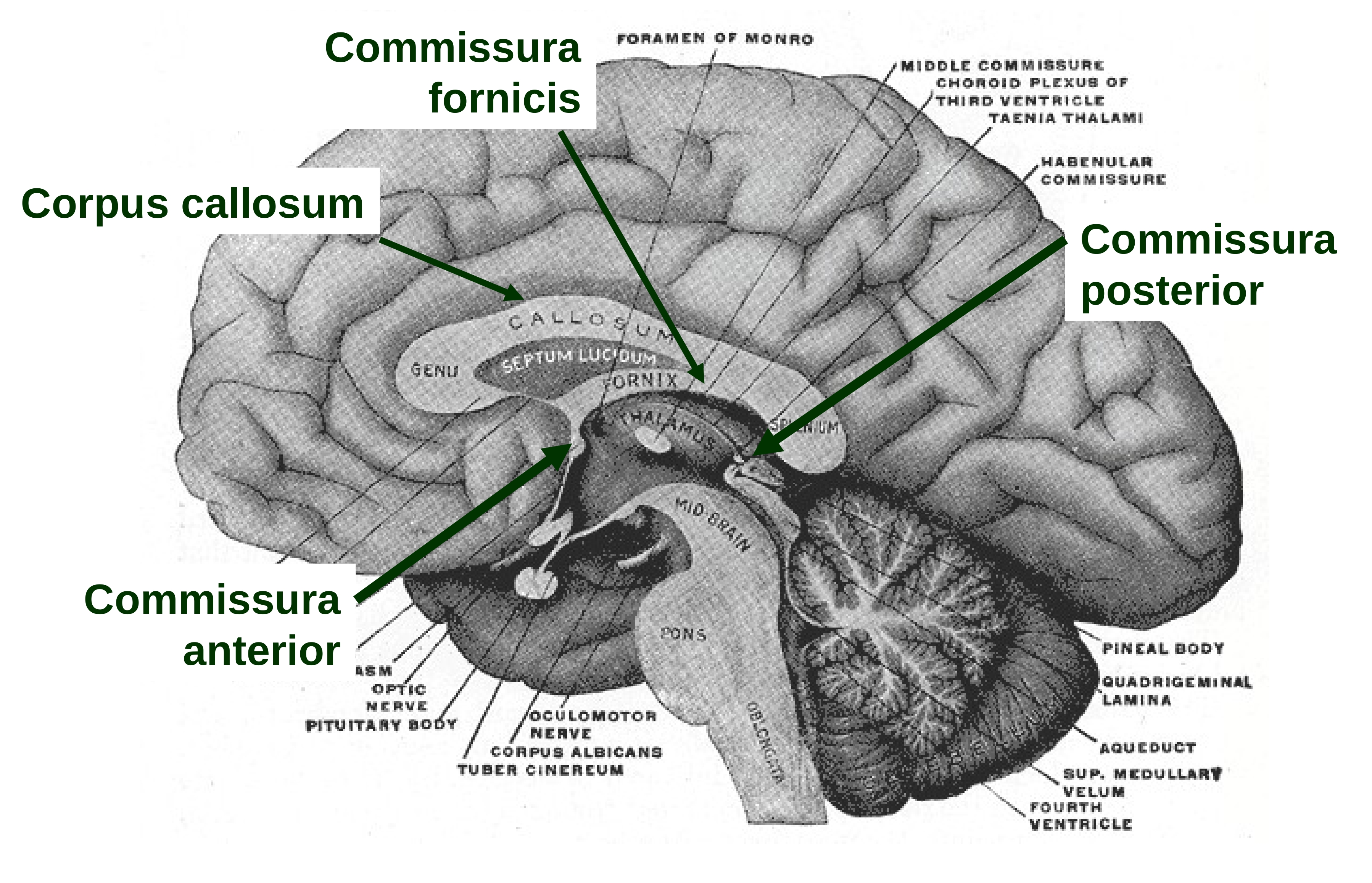 Воспаление головного мозга латынь. Комиссура Антериор. Сагиттальный срез мозга. Эпиталамическая спайка промежуточного мозга. Медиальная поверхность головного мозга.