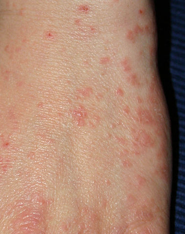 Under EYE rash irritation | Skin Itching & Rashes ...